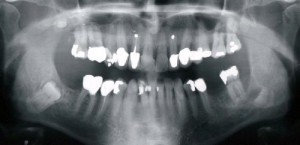 X-Ray After Removal